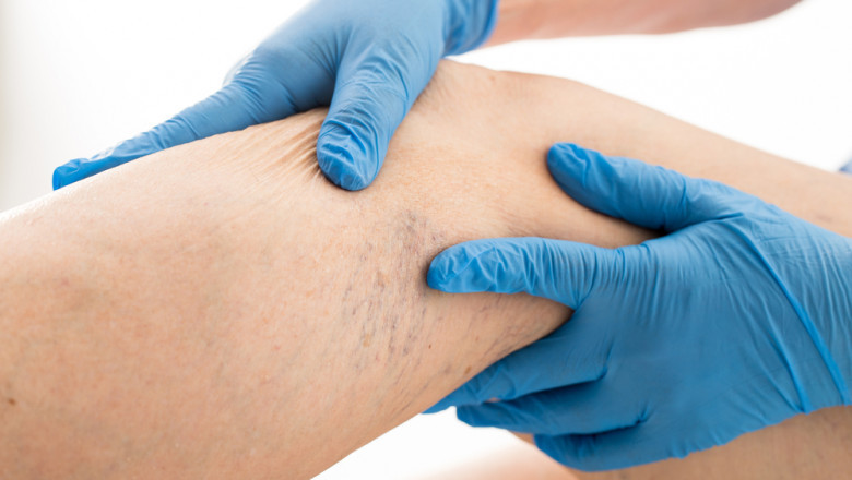 Global Varicose Veins Treatment Market Restraints