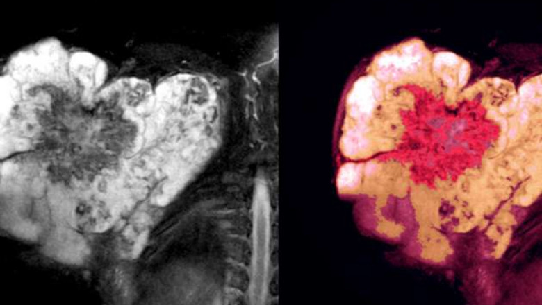 Soft Tissue Sarcoma Treatment Market By Type, Application, By Country, Forecast, 2014 - 2025