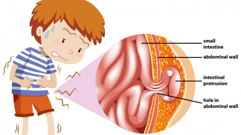 Hernia Symptoms & Treatment