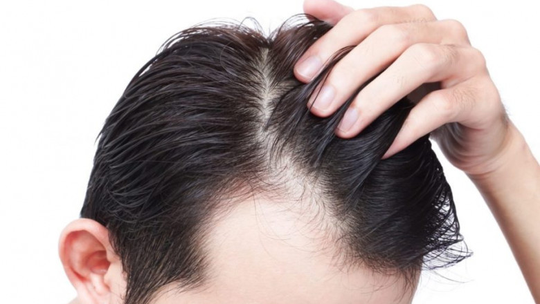 How Much Does It Cost To Get Hair Transplant In India?