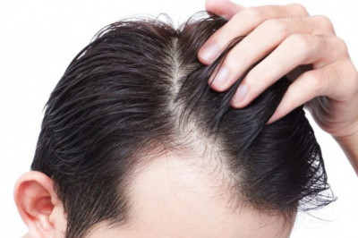 How Much Does It Cost To Get Hair Transplant In India?