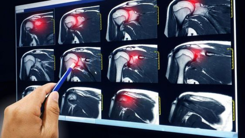 Rotator Cuff Repair Surgery- What Happens Afterwards