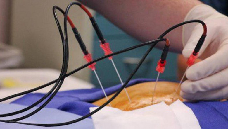 Endometrial Ablation Market Tendencies, Revenue Forecast, and Interesting Opportunities from 2022 to 2030