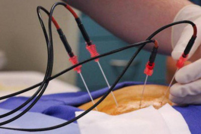 Endometrial Ablation Market Tendencies, Revenue Forecast, and Interesting Opportunities from 2022 to 2030