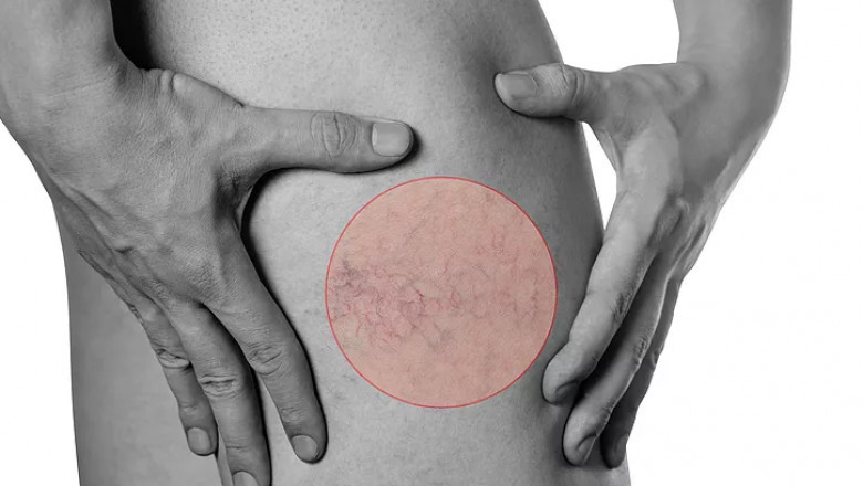 Fast Facts About Spider Vein Treatment