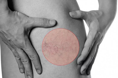 Fast Facts About Spider Vein Treatment
