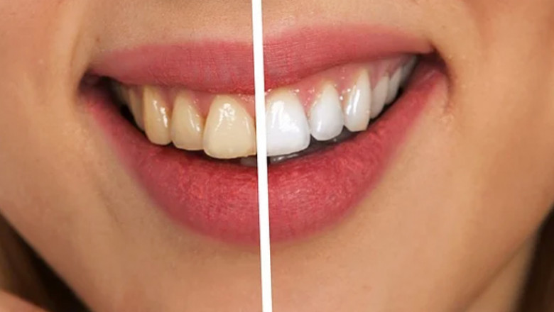 Comparison of Laser Teeth Whitening and LED cold light bleaching