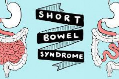 Global Short Bowel Syndrome Market Size, Market Share, Application Analysis, Regional Outlook, Growth Trends, Key Players, Competitive Strategies and Forecasts, 2017 to 2025