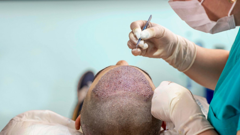 Hair Restoration Market Analytical Overview, Growth Factors, Demand and Trends Forecast to 2028