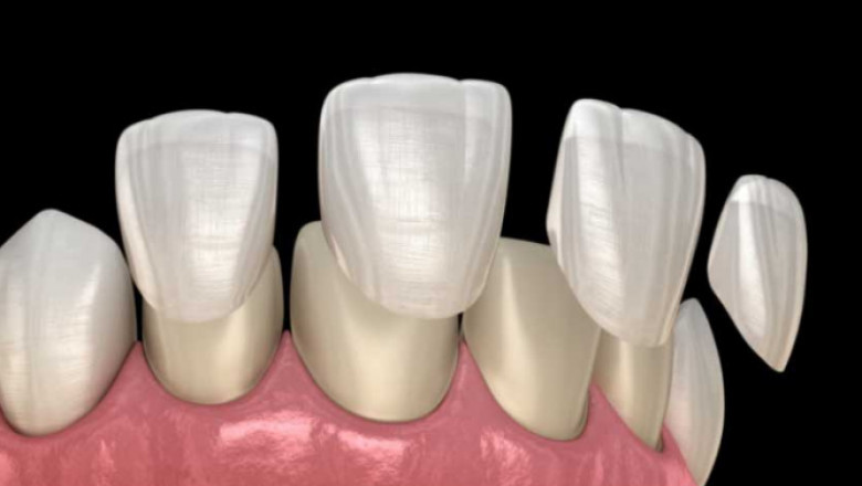 Benefits of Tooth Countering Services in Greenville