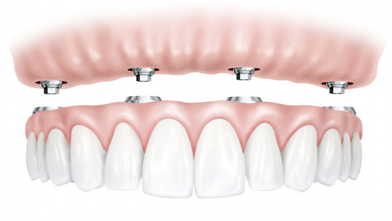 Outstanding Benefits of All-on-4 Dental Implants