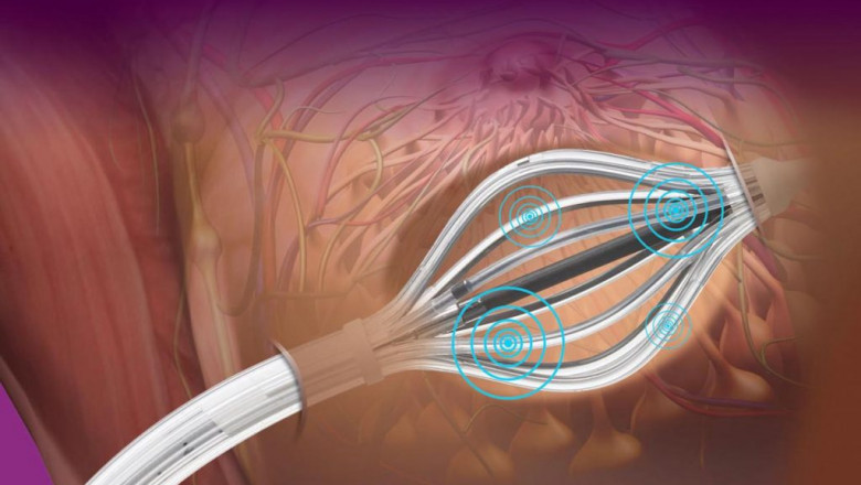 Brachytherapy Market Facts, Figures, and Analytical Insights 2021-2028