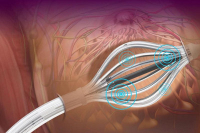 Brachytherapy Market Facts, Figures, and Analytical Insights 2021-2028