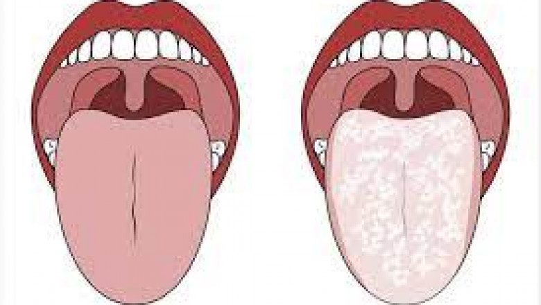 Global Candidiasis Market - Industry Trends and Forecast to 2028