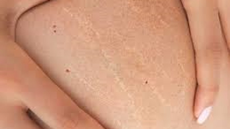 Why Everybody Is Talking About Best Stretch Mark Products