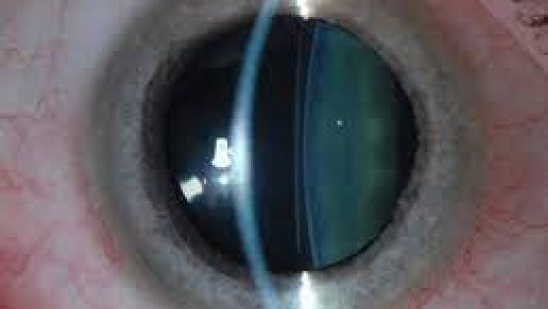 ICL Eye Surgery