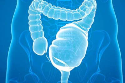 Ulcerative Colitis only affects the lining of the large intestine (colon) and rectum