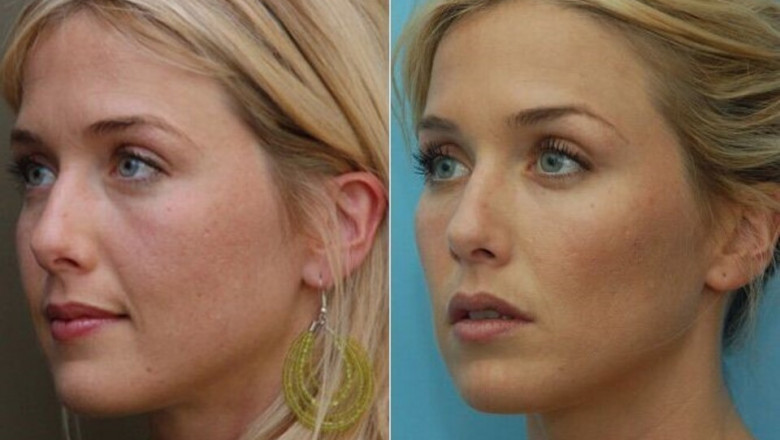 Facial Implants Have Become Popular Trend With Changing Lifestyle, Preferences And Growing Trend Of Facial Aesthetics