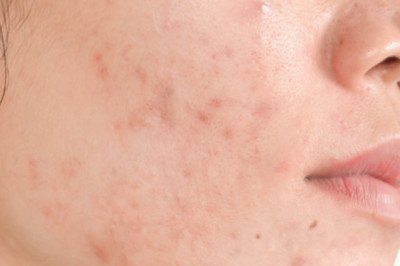 10 Common Ingredients in Cosmetics That May Cause Acne