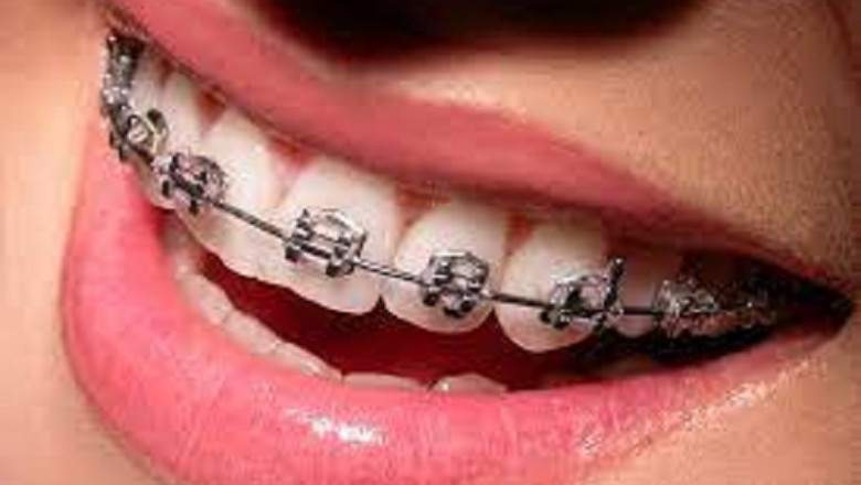 Dental Orthodontics Market Size, Research, Trends, Key Players, Overview Forecast By 2028 | 3D Systems, Inc.; 3M; 3Shape A/S