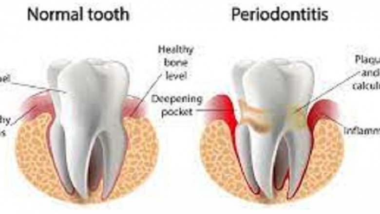 Dental Periodontics Market Size, Share, Forecast, & Industry Analysis 2028