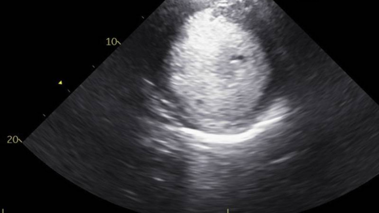 Echocardiography in Pimpri Chinchwad | Dr. Kartik Bhosale