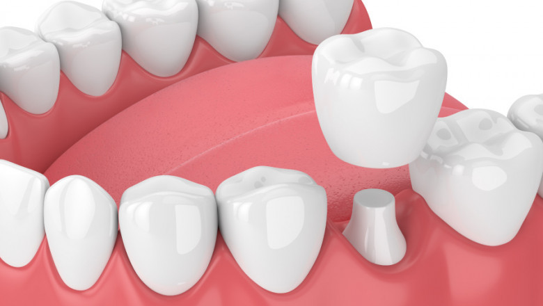 What Do You Mean By Dental Crowns?