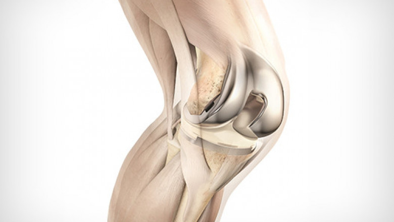 Total Knee Replacement Surgery Cost in Hyderabad