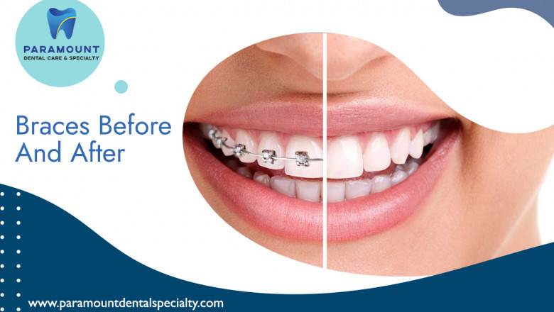 Braces Before And After