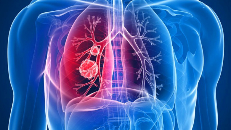 Cushing’s Syndrome Market Regional Analysis