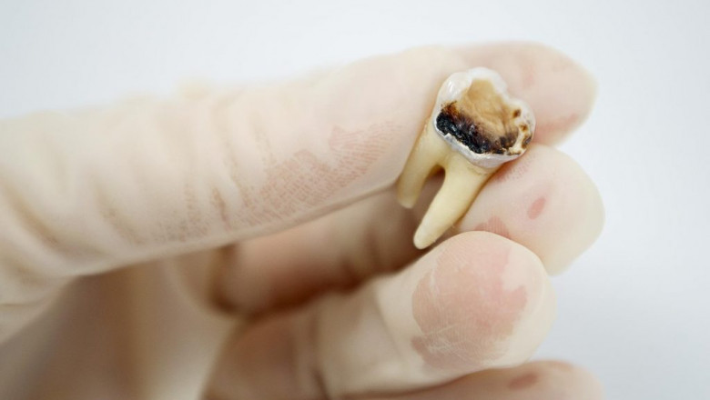 Top 6 Little-Known Tooth Decay Facts You Should Be Aware of