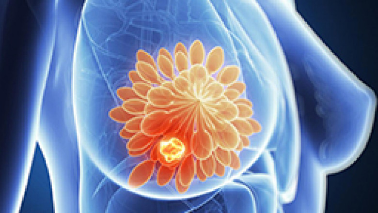 Best Breast Cancer Surgery in India