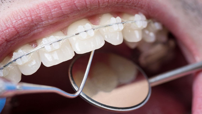 Orthodontic Supplies Market Size & Share Analysis with Industry Overview, CAGR, Trends, Scope, Demand, Opportunity