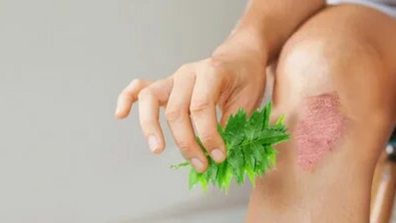 Eczema Therapeutics Market Recovering From breakout in 2022 | Research Informatic