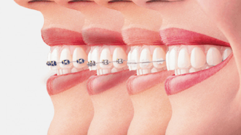 Need Of Using Quality Lingual Braces Malaysia
