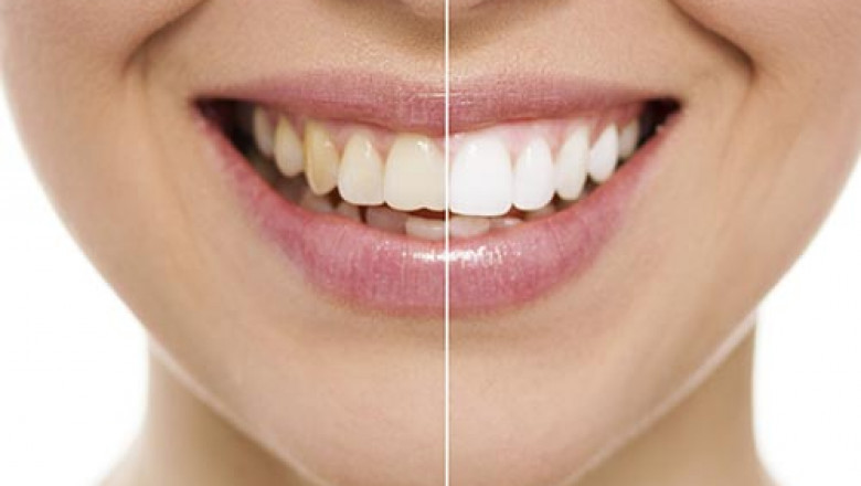 Why Dental Implants Are Important?