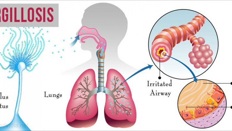 Aspergillosis Treatment Market Dynamics