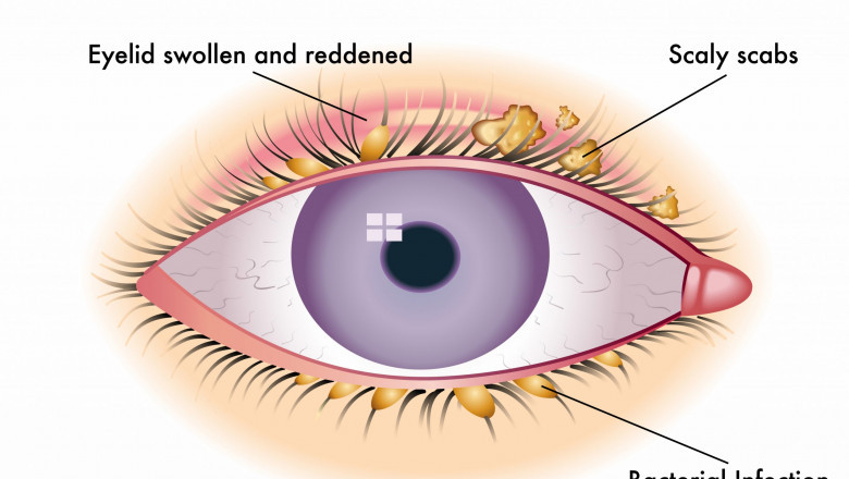 Blepharitis Treatment Market Drivers