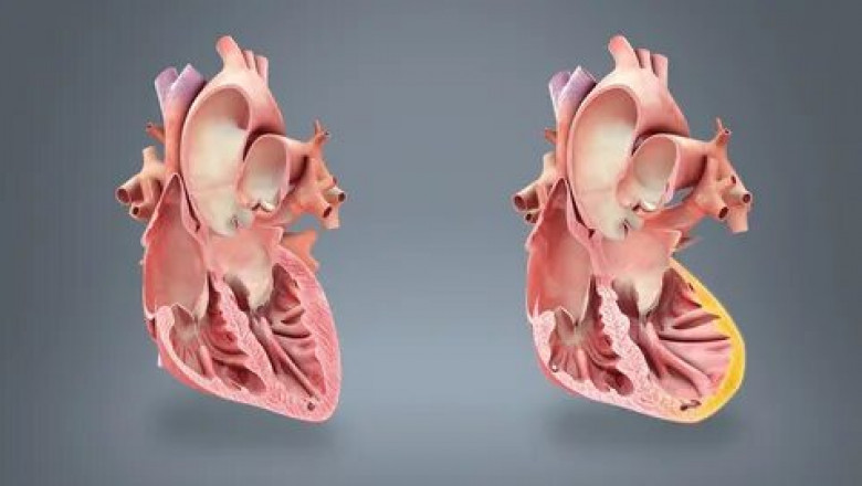 Myocardial Infarction Market - Global Opportunity Analysis and Industry Forecast, 2022-2029