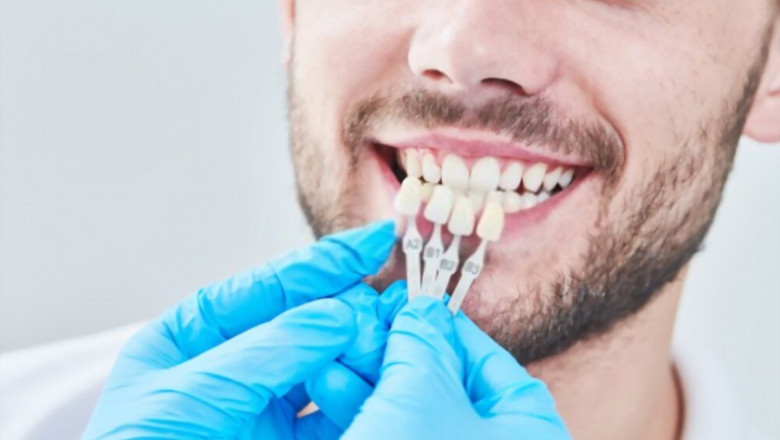 Porcelain Veneers: The Secret Behind a Sparkling Smile!