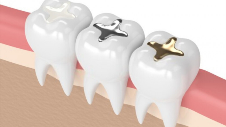 What are dental fillings?
