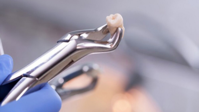 What can you eat after wisdom teeth extraction?