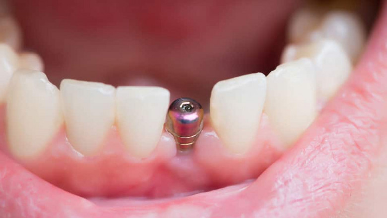 What More Do You Need To Know About Tooth Abscesses?