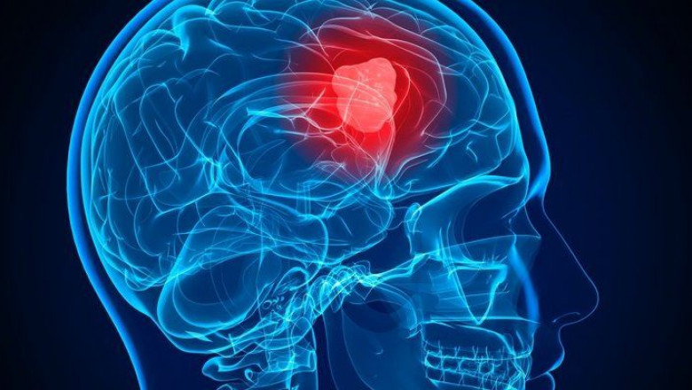Glioblastoma Multiforme (GBM) Treatment Market Development Analysis 2022 to 2030