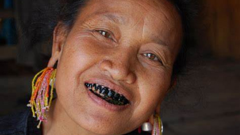 Why Do I Have Black Stains on Teeth?