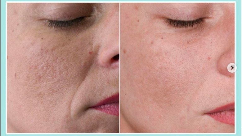 Microneedling Treatment Garden Grove