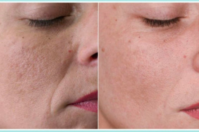 Microneedling Treatment Garden Grove