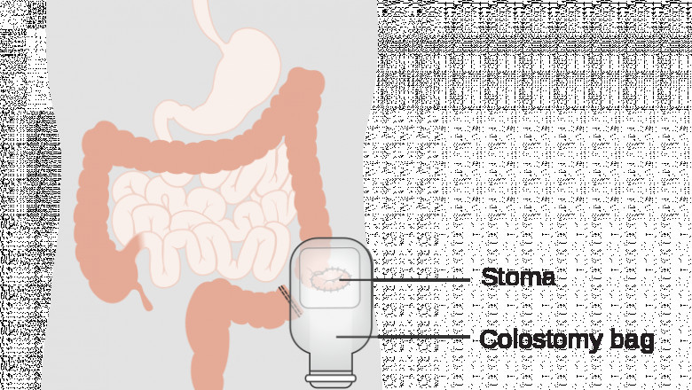 Ostomy/Stoma Care Market to Witness Robust Expansion During the Forecast Year 2021-2028