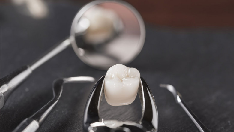 Why Wisdom Teeth Removal Is Good Your Health?