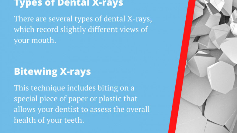 Do I Really Need X-Rays Every year? | Emergency Dental Service